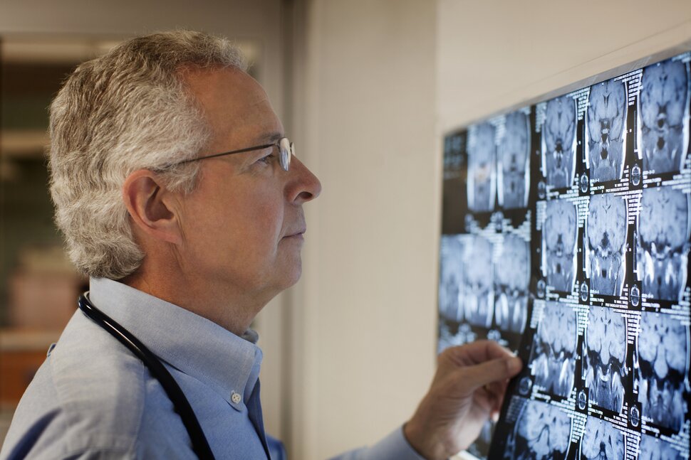 Une étude du CDC montre une augmentation des accidents vasculaires cérébraux chez les jeunes adultes